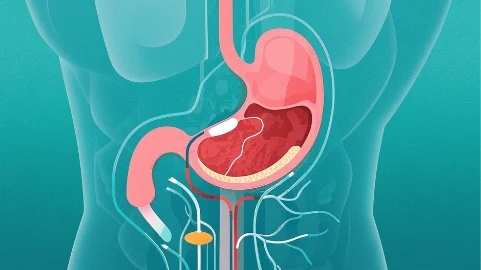 急性胃黏膜病变:综合诊断与治疗指南