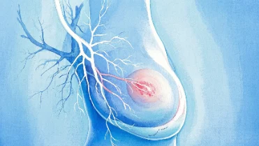 乳腺癌四期——各个阶段的斗士怎样与疾病共舞!
