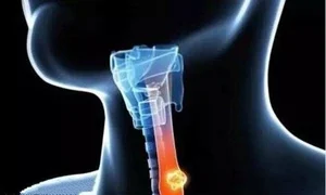 食管癌 - 用药指南与治疗建议 - 知识科普、百姓健康、科普中国认证