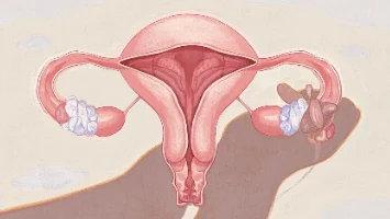 女性健康守护:认识与预防卵巢囊肿