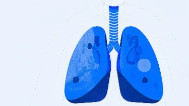 肺部结节与肺癌术后管理:科学诊断与有效治疗