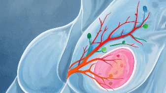 乳腺癌二期：警示与希望