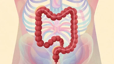 震惊！直肠癌三期患者如何应对？——健康生活从预防开始