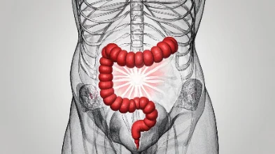 直肠癌:了解病因、治疗方法及预防措施