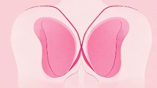 战胜乳腺癌：从早期诊断到健康生活的全攻略