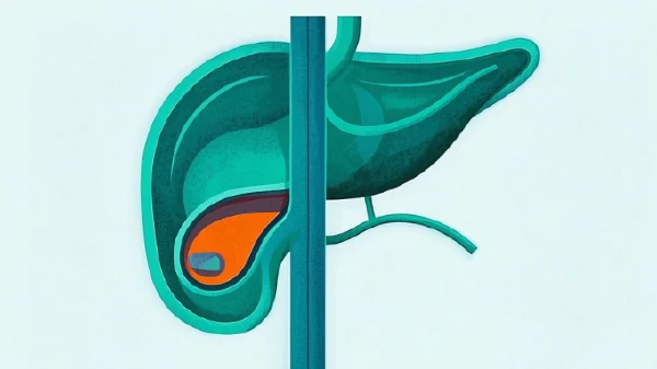 胆囊结石早发现早治疗：看懂体检报告，拥抱健康生活