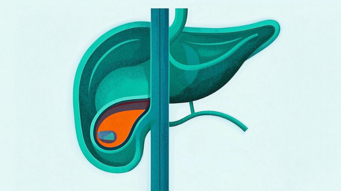 科普,胆囊结石早发现早治疗:看懂体检报告,拥抱健康生活封面图