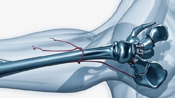 肱骨外科颈骨折：护理与预防的全攻略