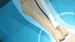 右腓骨骨折的全面解析与科学管理