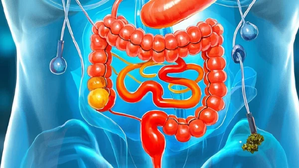 抗击结直肠癌：深入了解与预防措施全解读