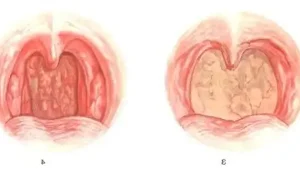 急性咽炎的全面解析