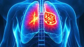 肺腺癌——早期识别与科学应对的实用指南