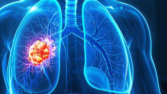 科普，<span style="color: #da4707">小</span><span style="color: #da4707">细胞</span><span style="color: #da4707">肺癌</span>：认识、早期<span style="color: #da4707">症状</span>、有效应对