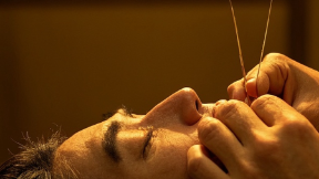 用针灸解锁偏头痛的秘密：穴位与配伍的奇妙之旅