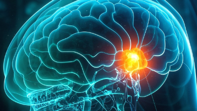 科普,脑继发恶性肿瘤:识别、诊断与治疗的全面指南封面图