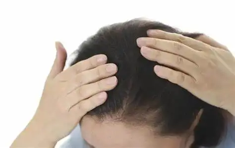 头皮竟然也会长霉菌!——揭秘头藓真相