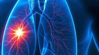 科普，肺癌知多少？了解风险与应对策略封面图