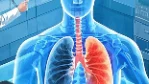 恶性胸腔积液:隐秘于胸腔的“恶魔”与其抗争之路