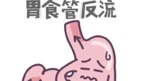 反流性食管炎:全面解析及管理策略