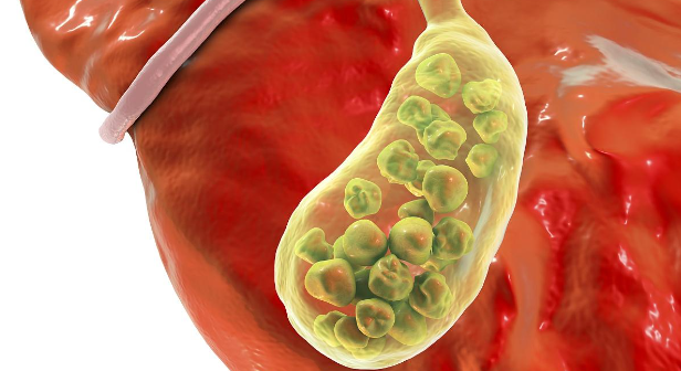 揭秘胆囊结石：预防与治疗全攻略