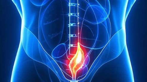 腹股沟疝:从诊断到治疗的科学指南