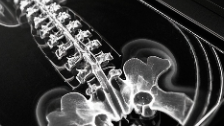 科普，透视脊柱健康：全脊柱MRI<span style="color: #da4707">扫描</span>的奥秘与应用