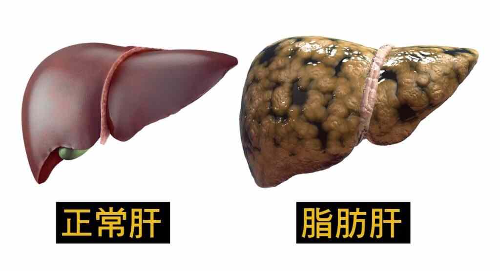 脂肪肝：现代人不得不注意的健康警钟封面图