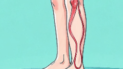 科普，<span style="color: #da4707">静脉</span>曲张的解密：下肢<span style="color: #da4707">静脉</span>剥脱<span style="color: #da4707">术</span>的全景漫游