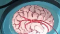 探索脑血管瘤栓塞术:穿越神经血管的科学奥秘