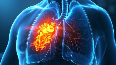科普，肺癌：实用<span style="color: #da4707">指南</span>，让你更懂这个<span style="color: #da4707">疾病</span>