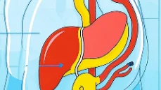 当胆道遭遇“交通堵塞”：解读胆道梗阻的真相