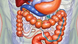 战斗在肠道:结肠恶性肿瘤 IIIIC期中的中分化管状腺癌治疗方案解析