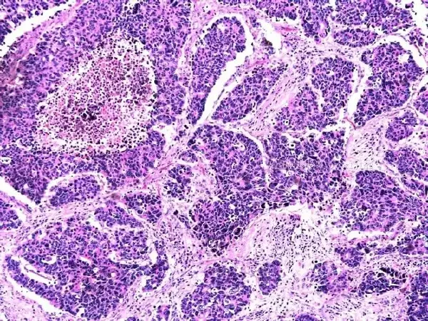 结肠肿物的诊断与治疗：现代医学的前沿探索