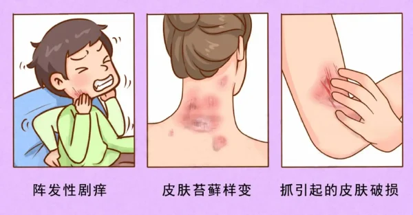 应对特应性皮炎的新希望——科学用药指导!
