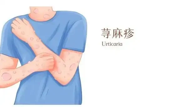 全面解析荨麻疹：从诊断到管理