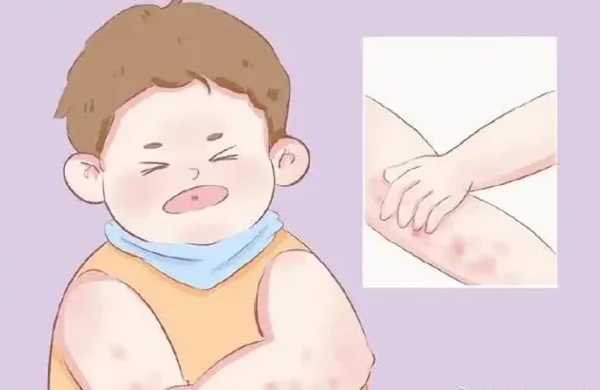 过敏性皮肤炎怎么办?皮肤医生教您对抗过敏的秘诀!