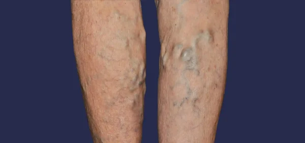 从初诊到康复：下肢静脉功能不全的全面管理指南