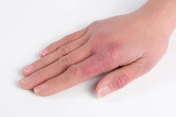 湿疹：皮肤上的隐形敌人！