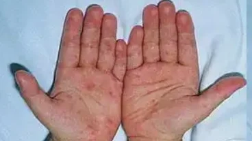 如何预防和治疗荨麻疹：从过敏反应中保护自己