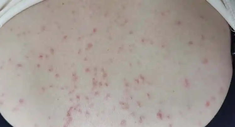 揭开过敏性皮炎的神秘面纱！—从药物治疗入手封面图