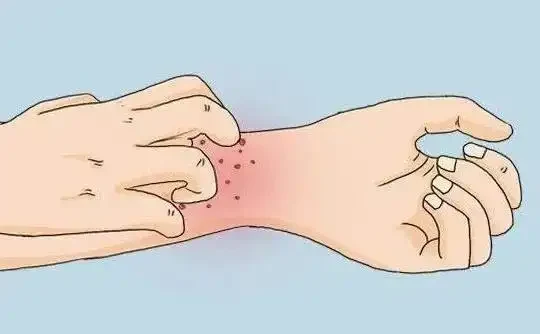 慢性荨麻疹、特应性皮炎和睡眠障碍——三种常见疾病，你都了解吗？