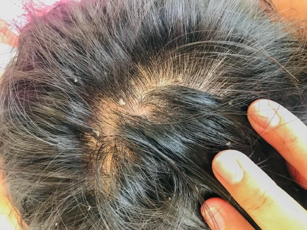 了解并战胜脂溢性皮炎和体癣——你的健康指南!