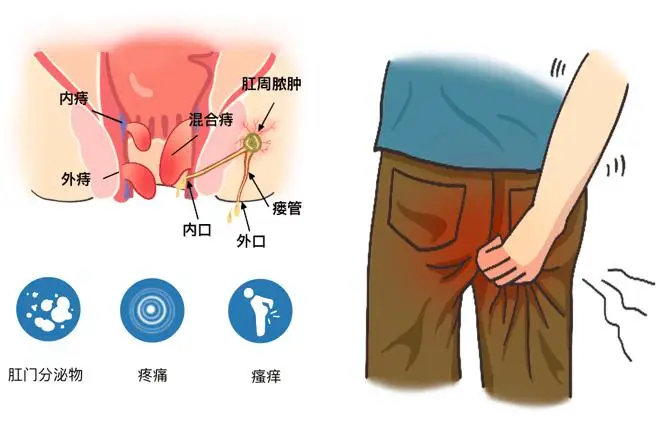 肛瘘：沉默的隐患，如何预防与治疗封面图