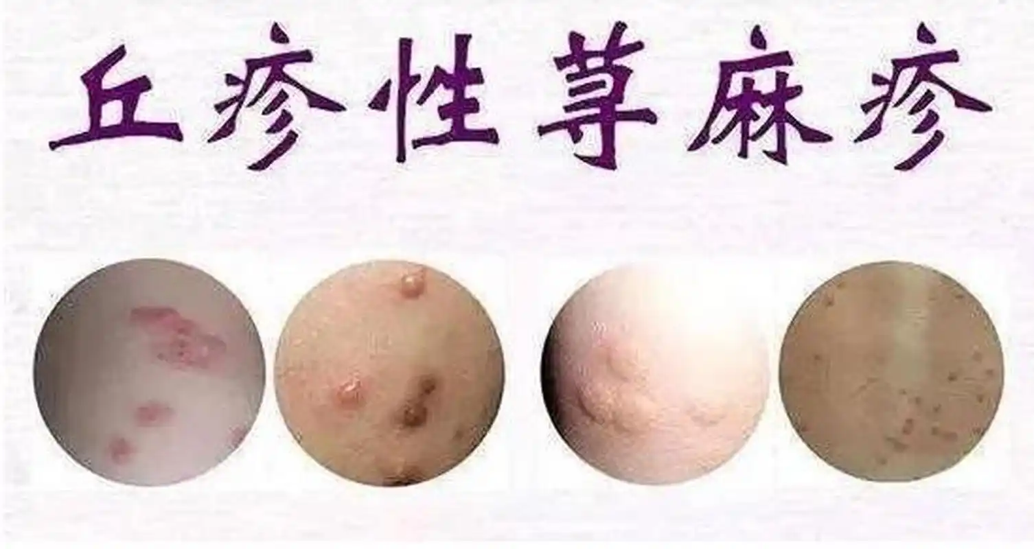 了解<span style="color: #da4707">丘疹</span>性荨麻疹及其预防——老年患者须知