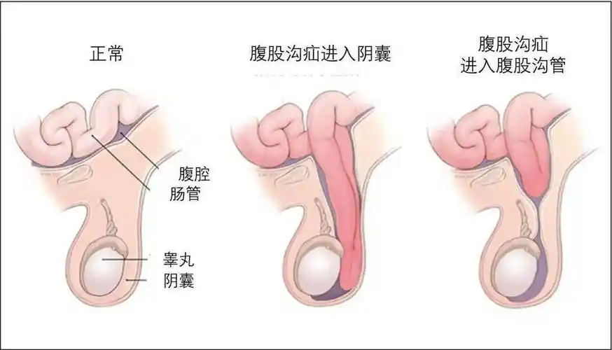 腹股沟疝的诊断与治疗：<span style="color: #da4707">现代医学</span>视角