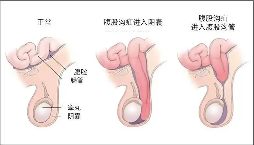 腹股沟疝的诊断与治疗：现代医学视角