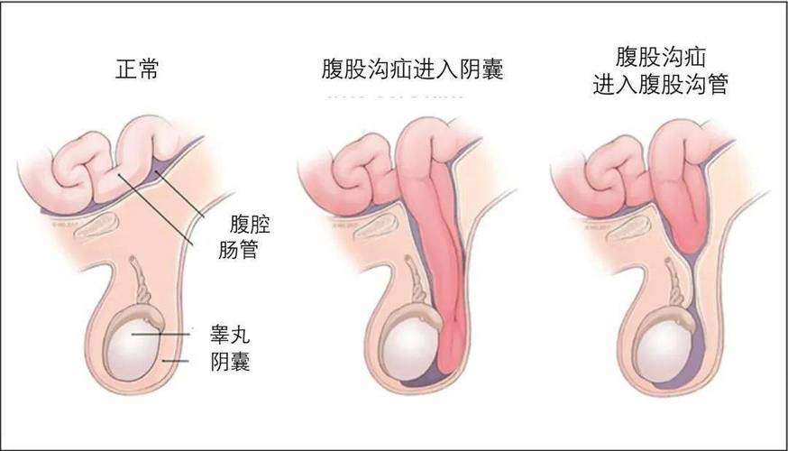 莫忽视<span style="color: #da4707">腹股沟</span>的隐痛——详解<span style="color: #da4707">腹股沟</span><span style="color: #da4707">疝</span>及其处理方法！