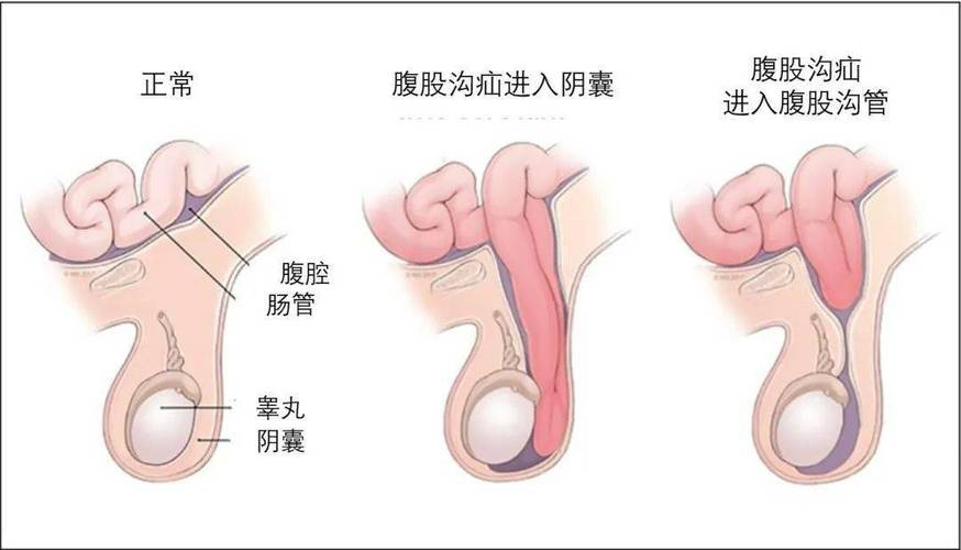 莫忽视腹股沟的隐痛——详解腹股沟疝及其处理方法！