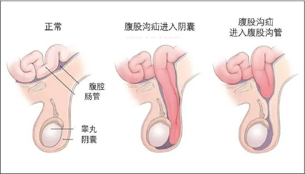 莫忽视腹股沟的隐痛——详解腹股沟疝及其处理方法！