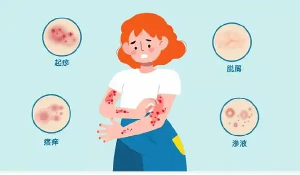 全面解读神经性皮炎：诊断、分期与治疗策略